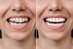 Before and After Pics